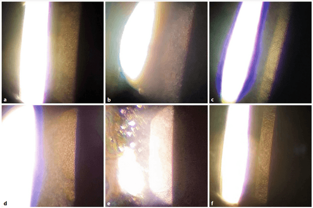 corneal endothelial cells (CECs)