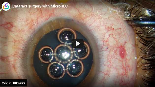 an brown eye with big pupil ready for a surgery