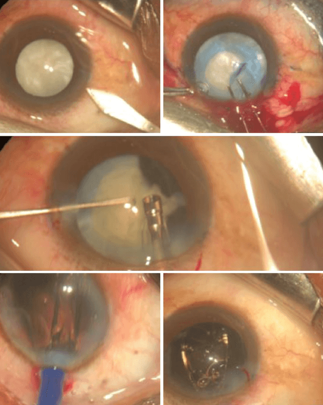 White hard cataract surgery in Kenya expedition